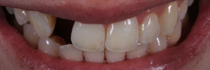 Before Dental Implant crown procedure