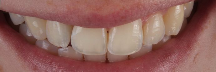 After Dental Implant crown procedure